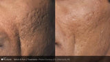 PicoSure Revitalization