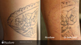 PicoSure Tattoo Removal