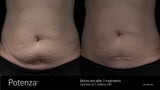 Potenza Radiofrequency Microneedling