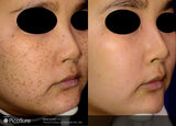 PicoSure Tattoo Removal
