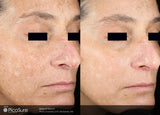 PicoSure Revitalization