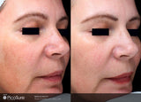 PicoSure Tattoo Removal