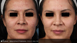 PicoSure Revitalization
