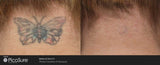 PicoSure Tattoo Removal