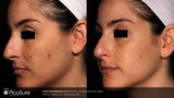 PicoSure Pigment