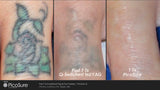 PicoSure Tattoo Removal