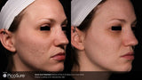 PicoSure Revitalization