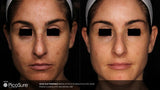 PicoSure Pigment