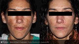 PicoSure Pigment