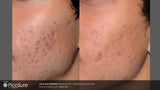 PicoSure Revitalization