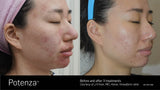 Potenza Radiofrequency Microneedling