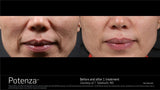 Potenza Radiofrequency Microneedling