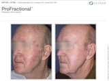 TRL ProFractional Laser with Exosomes