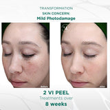 VI Peel Treatment