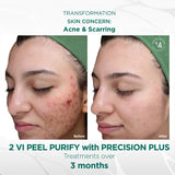 VI Peel Treatment