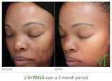 VI Peel Treatment