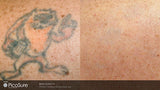 PicoSure Tattoo Removal