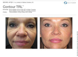Contour TRL Laser