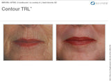 Contour TRL Laser