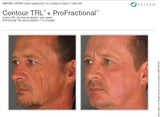 Contour TRL Laser