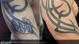 PicoSure Tattoo Removal