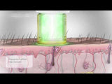 Laser Hair Removal