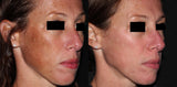PicoSure Pigment
