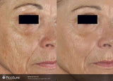 PicoSure Revitalization