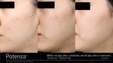 Potenza Radiofrequency Microneedling