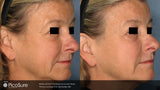 PicoSure Revitalization