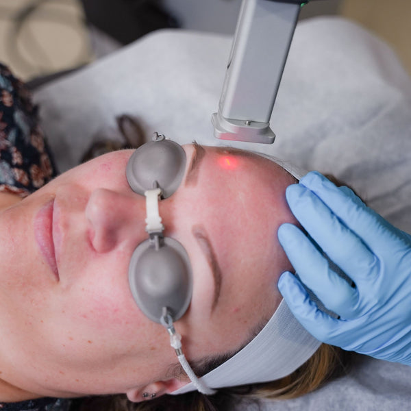 HELIX C02 Laser Resurfacing Treatment