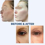 HELIX C02 Laser Resurfacing Treatment