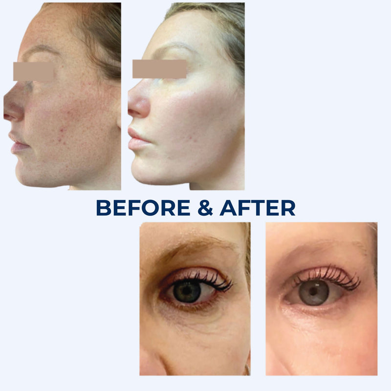 HELIX C02 Laser Resurfacing Treatment
