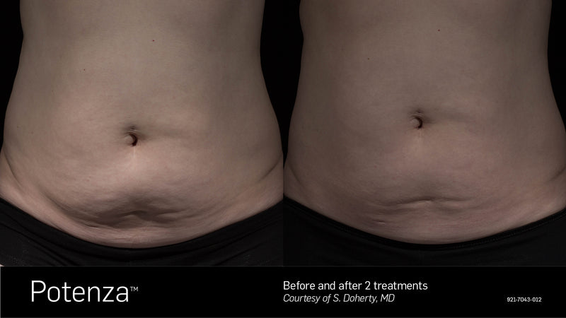 Potenza Rfm Potenza Radiofrequency Microneedling – Texas Dermatology Med Spa