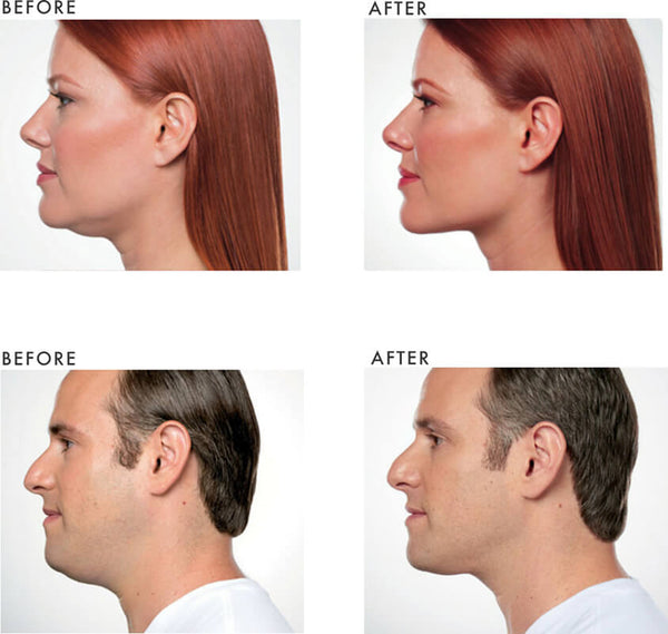 Kybella Package