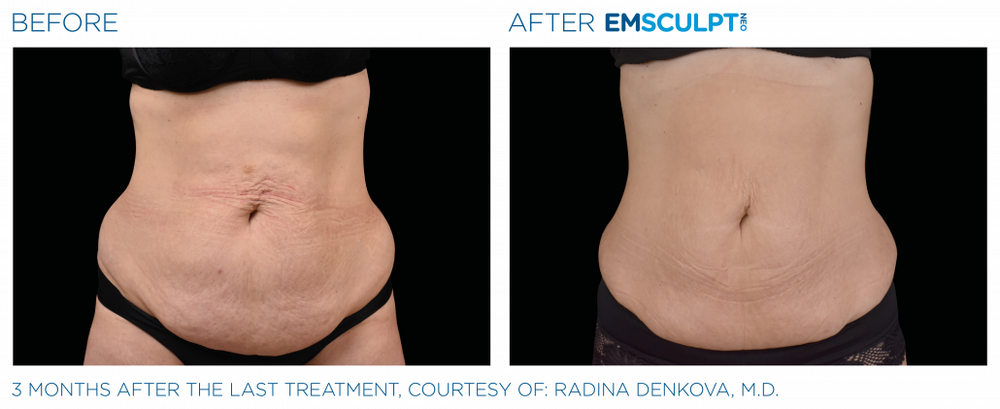 Emsculpt Neo – Texas Dermatology Med Spa