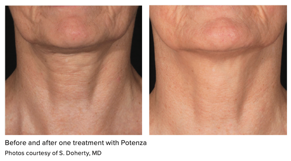 Potenza Radiofrequency Microneedling