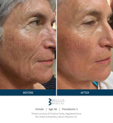 SkinPen Microneedling Treatment