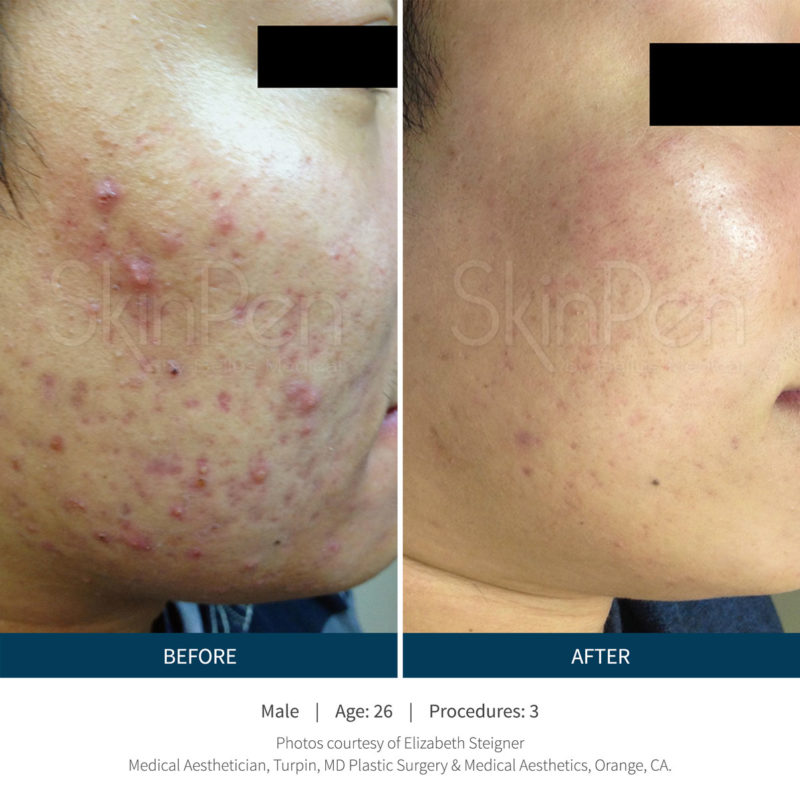 SkinPen Microneedling Treatment