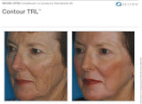 Contour TRL Laser