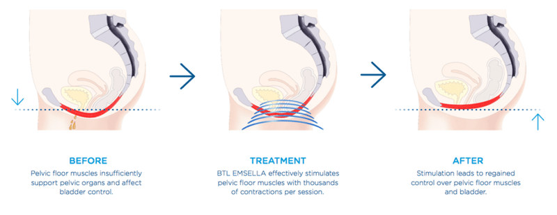 Emsella Treatment