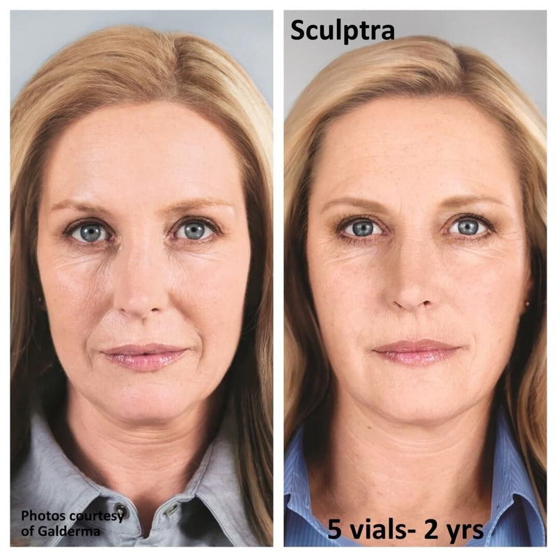 Sculptra Package